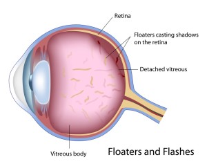 floaters and flashes in the eye