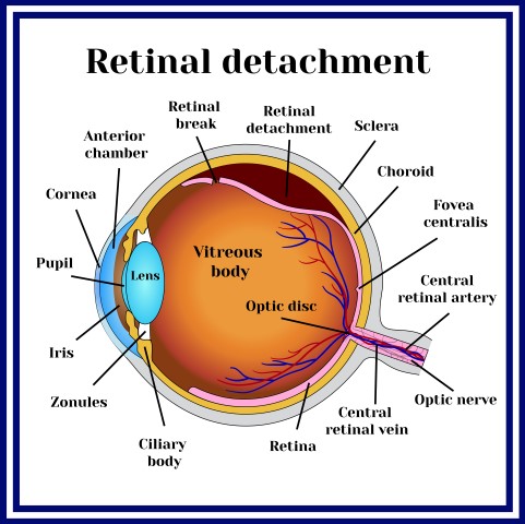 repairing a detached retina