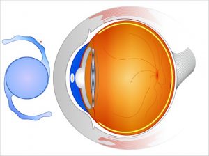 What Are Intraocular Lenses and How Can They Help Your Eyesight