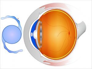 What-Are-Intraocular-Lenses-and-How-Can-They-Help-Your-Eyesight-300x224