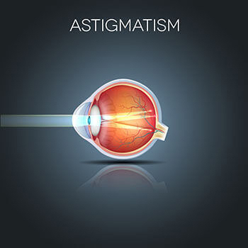 Astigmatism diagram